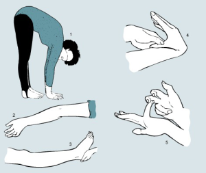 "The Beighton scale ... [Beighton et al., 1983]...  Forward flexion of the trunk with knees fully extended so that the palms of the hand rest flat* on the floor – one point Hyperextension of the elbows beyond 10 degrees* – one point for each elbow Hyperextension of the knees beyond 10 degrees* – one point for each knee Passive apposition of the thumbs to the flexor aspect of the forearm* – one point for each hand Passive dorsiflexion of the little fingers beyond 90 degrees* – one point for each hand  *Note: Picture may indicate a degree of hypermobility not required by the diagnostic criteria."